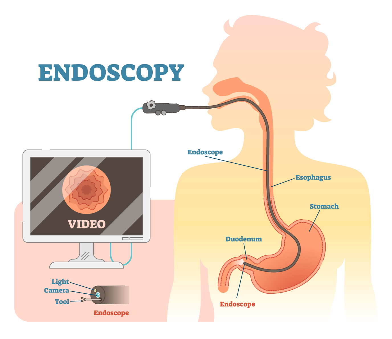 Endoscopy / Colonoscopy Surgery in Sydney
