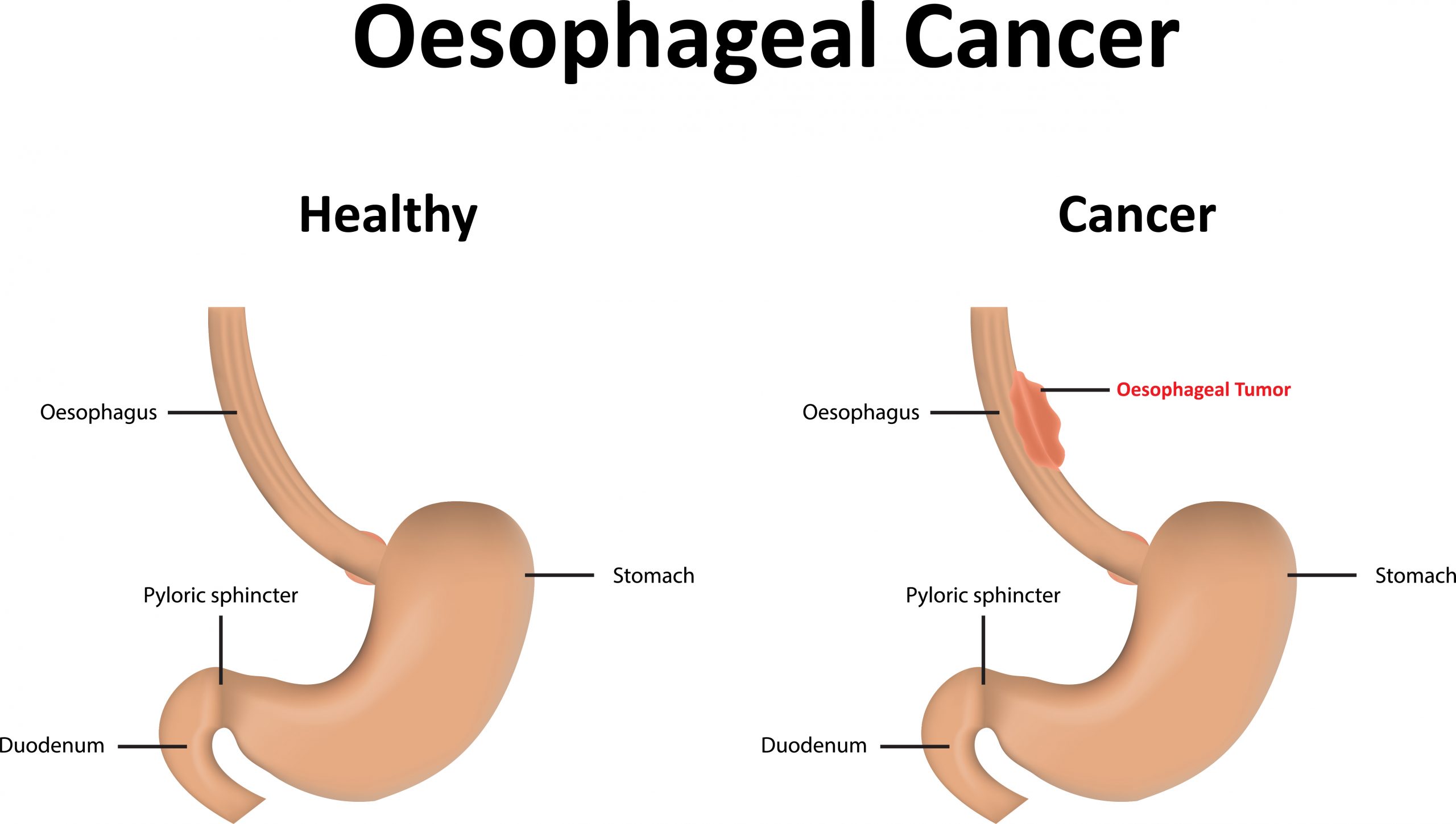 Stomach/Oesophageal Cancer Surgery