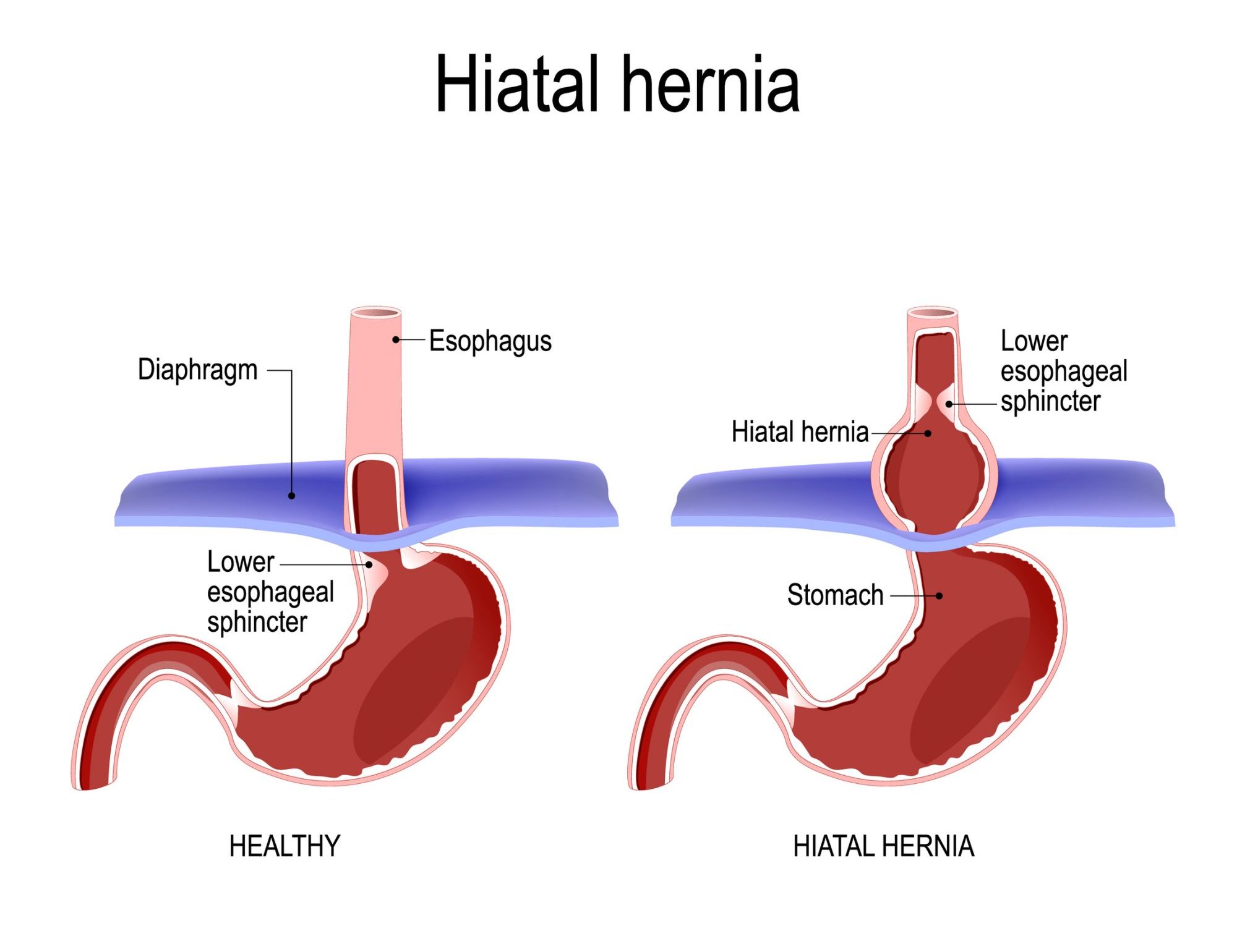 Reflux / Hiatus Hernia Surgery