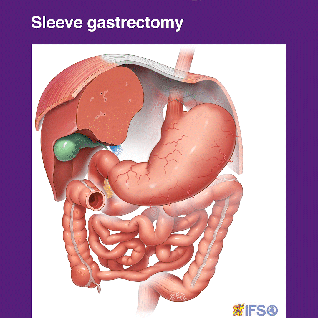 Laparoscopic Sleeve Gastrectomy - What You Need to Know